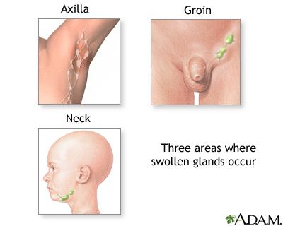 congestia ganglionilor